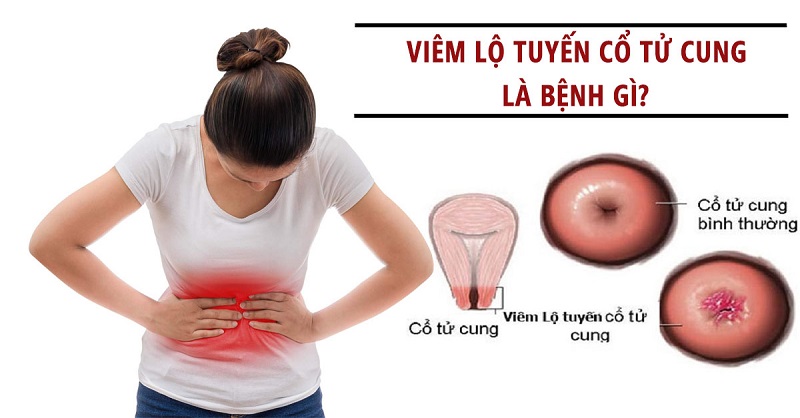 Hỏi đáp Bác sĩ: Viêm lộ tuyến cổ tử cung độ 2 có nên đốt không, không điều trị có sao không?